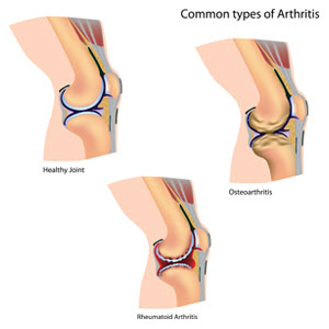 Types of arthritis
