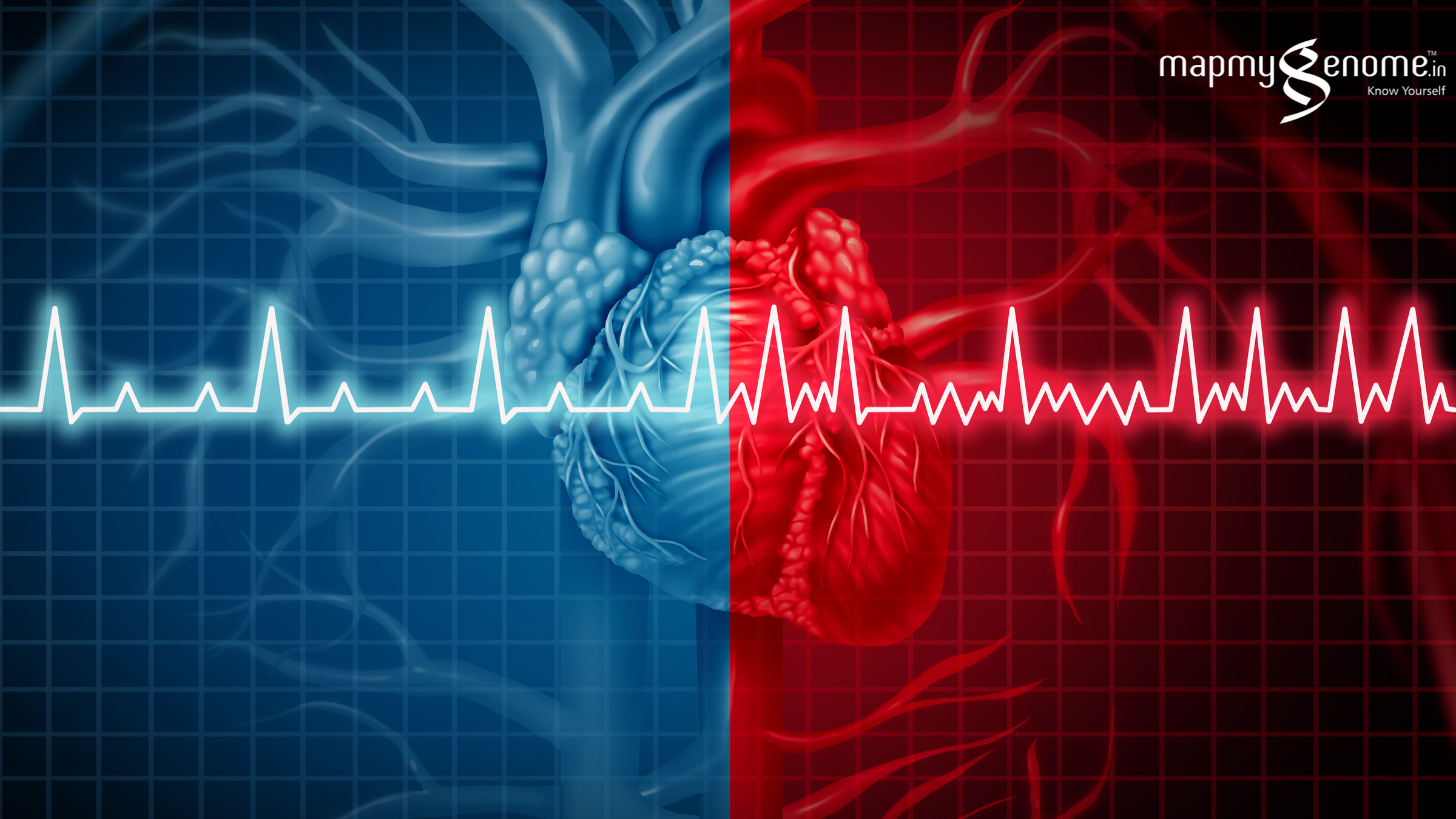 Lifestyle Disorders – Atrial Fibrillation and Stroke