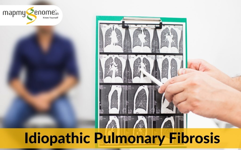                                             Idiopathic Pulmonary Fibrosis 